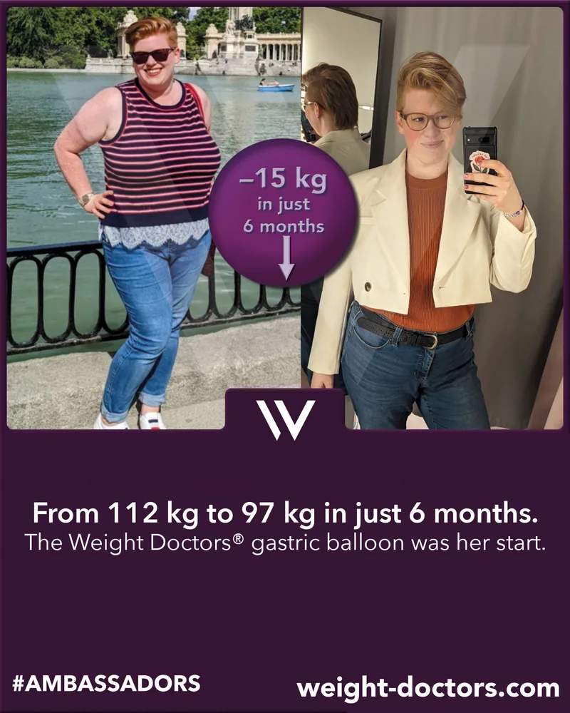 Weight Doctors® قبل وبعد: مريضة من 112 kg إلى 97 kg في ستة أشهر، مع Weight Doctors® بالون المعدة