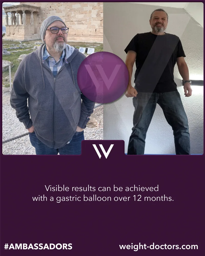 Weight Doctors® قبل وبعد: مريض قبل اثني عشر شهرًا مع Weight Doctors® بالون المعدة وبعدها