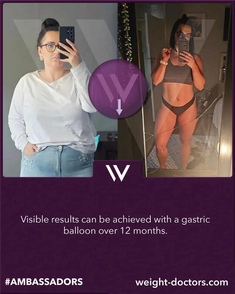 Weight Doctors® قبل وبعد: مريضة قبل اثني عشر شهرًا مع Weight Doctors® بالون المعدة وبعدها