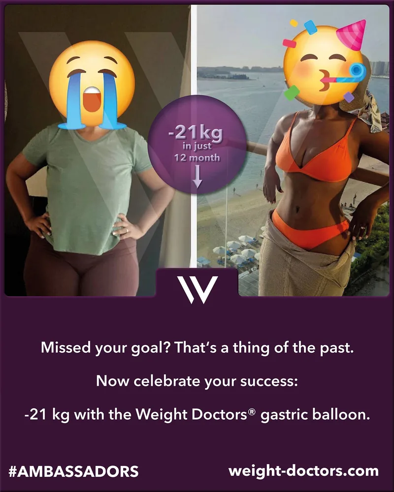 Weight Doctors® before and after: patient with 21 kg less in twelve months, with the Weight Doctors® GASTRIC BALLOON (faces covered)