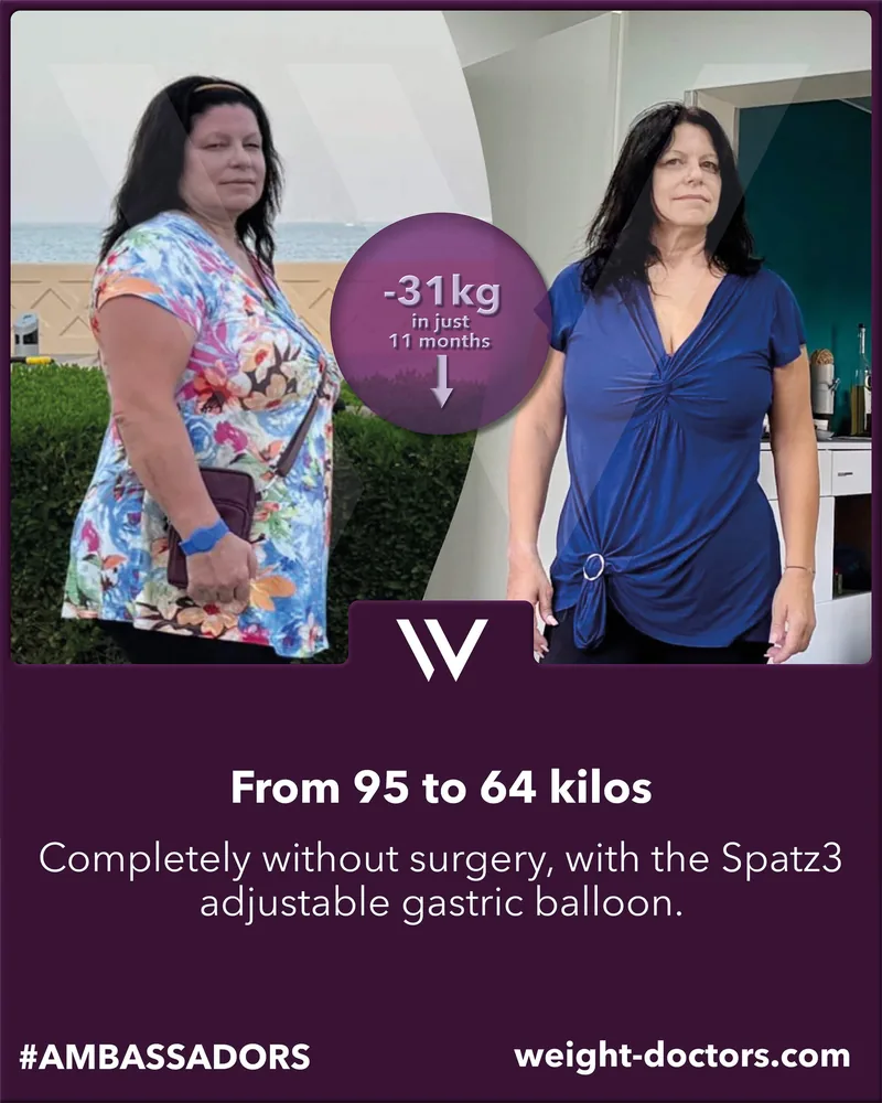 Weight Doctors® before and after: patient from 95 to 64 kilos entirely without surgery, with the adjustable Spatz3 gastric balloon