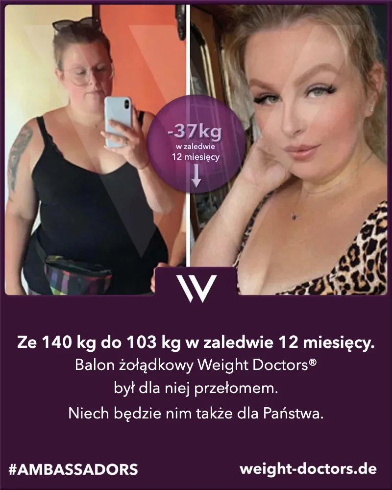 Weight Doctors® przed i po: pacjentka – ze 140 kg do 103 kg w dwanaście miesięcy, z Weight Doctors® BALON ŻOŁĄDKOWY