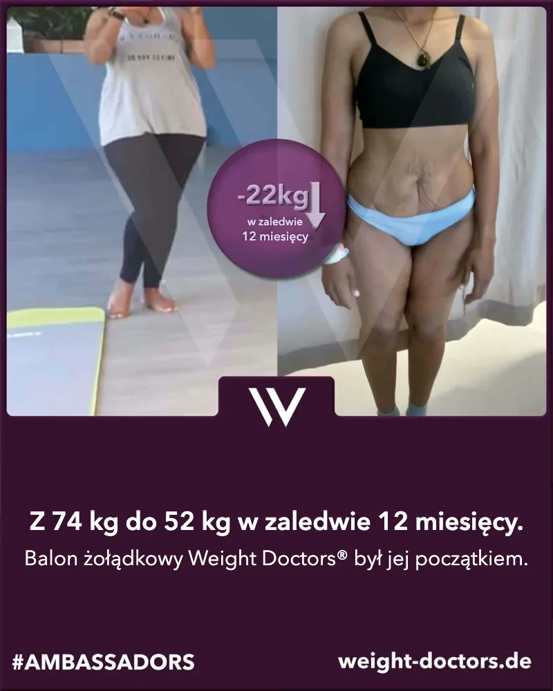 Weight Doctors® przed i po: pacjentka – ze 74 kg do 52 kg w dwanaście miesięcy, z Weight Doctors® BALON ŻOŁĄDKOWY