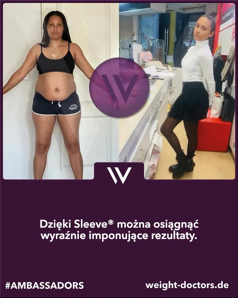 Weight Doctors® przed i po: pacjentka przed Weight Doctors SLEEVE® i po nim