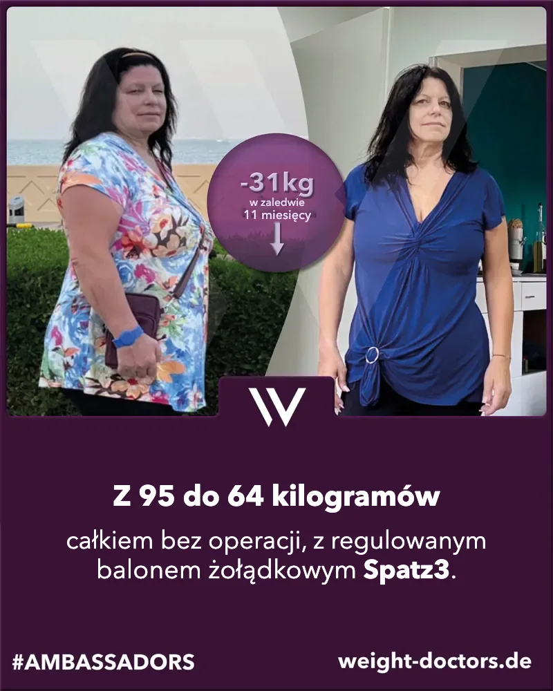 Weight Doctors® przed i po: pacjentka – z 95 do 64 kilogramów zupełnie bez operacji, z regulowanym balonem żołądkowym Spatz3