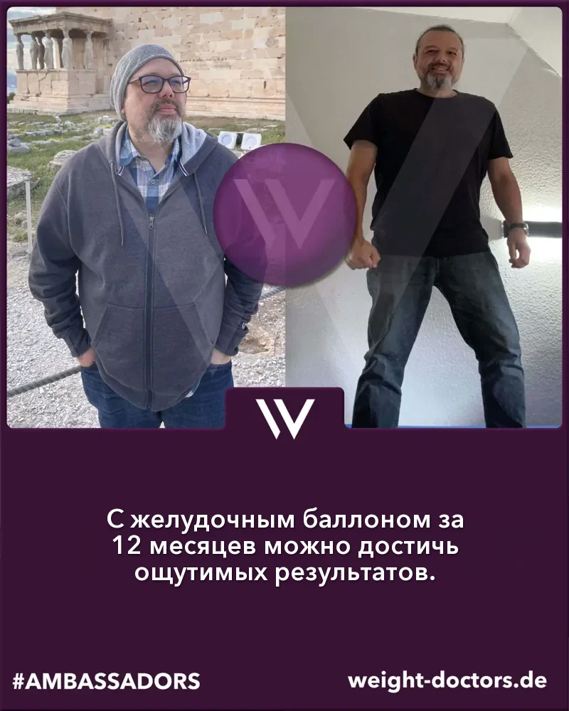 Weight Doctors® до и после: пациент до и через двенадцать месяцев с Weight Doctors® ЖЕЛУДОЧНЫЙ БАЛЛОН