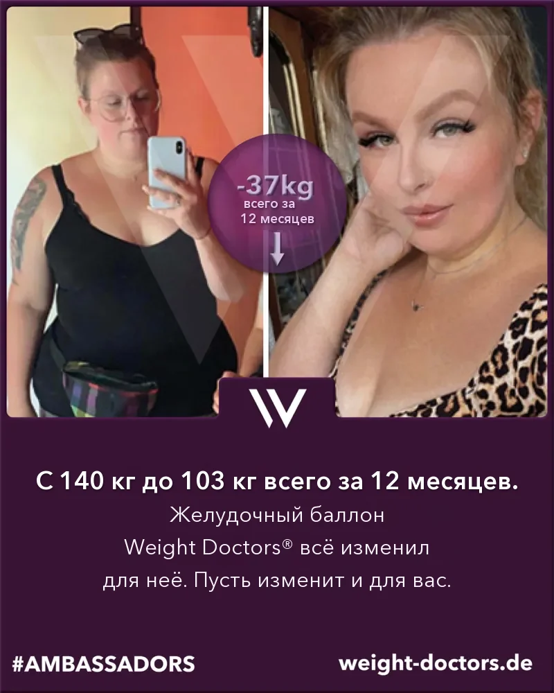 Weight Doctors® до и после: пациентка, со 140 кг до 103 кг за двенадцать месяцев с Weight Doctors® ЖЕЛУДОЧНЫЙ БАЛЛОН