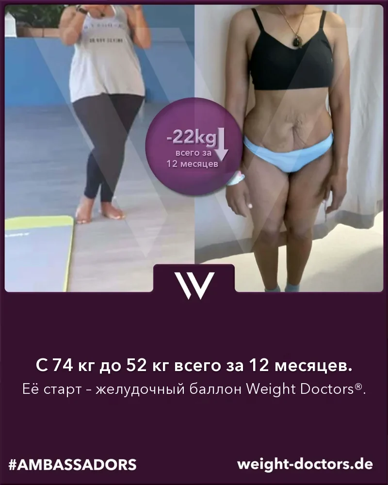 Weight Doctors® до и после: пациентка, с 74 кг до 52 кг за двенадцать месяцев с Weight Doctors® ЖЕЛУДОЧНЫЙ БАЛЛОН