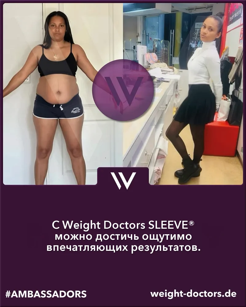Weight Doctors® до и после: пациентка до и после Weight Doctors SLEEVE®