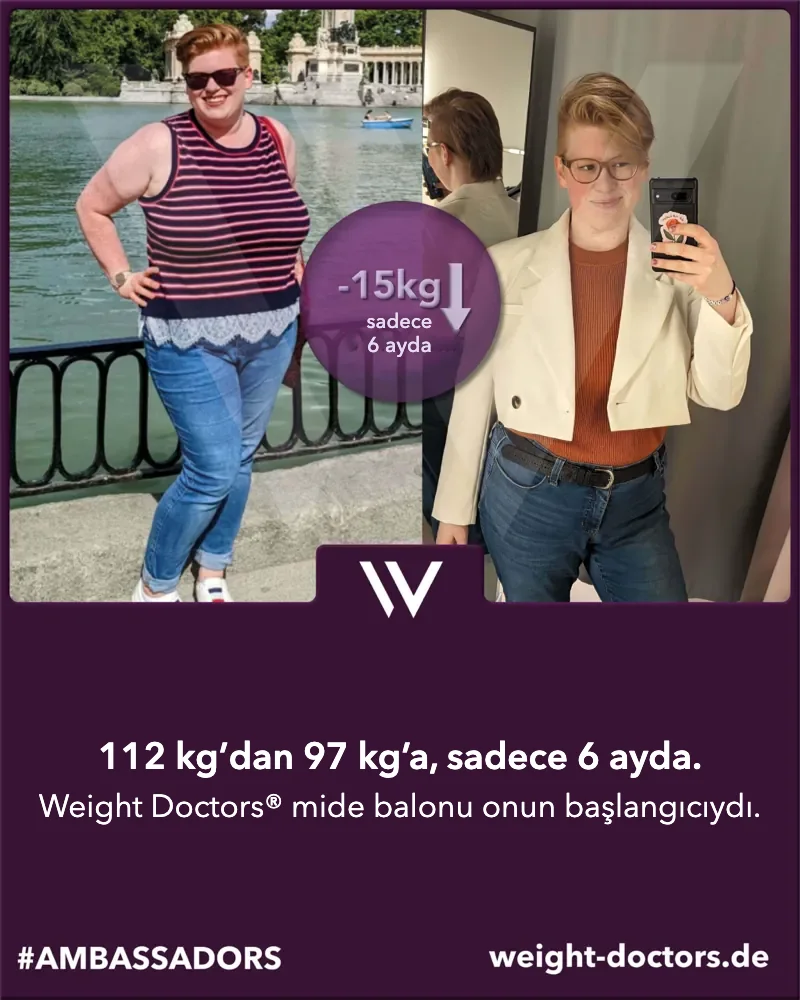 Weight Doctors® öncesi ve sonrası: kadın hasta, altı ayda 112 kg’dan 97 kg’a, Weight Doctors® MİDE BALONU ile