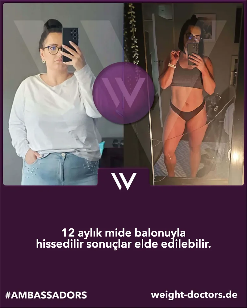 Weight Doctors® öncesi ve sonrası: kadın hasta, Weight Doctors® MİDE BALONU ile on iki ay öncesi ve sonrası