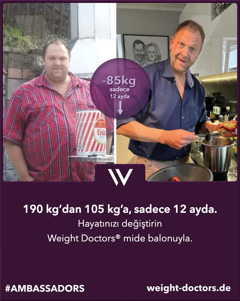 Weight Doctors® öncesi ve sonrası: erkek hasta, on iki ayda 190 kg’dan 105 kg’a, Weight Doctors® MİDE BALONU ile