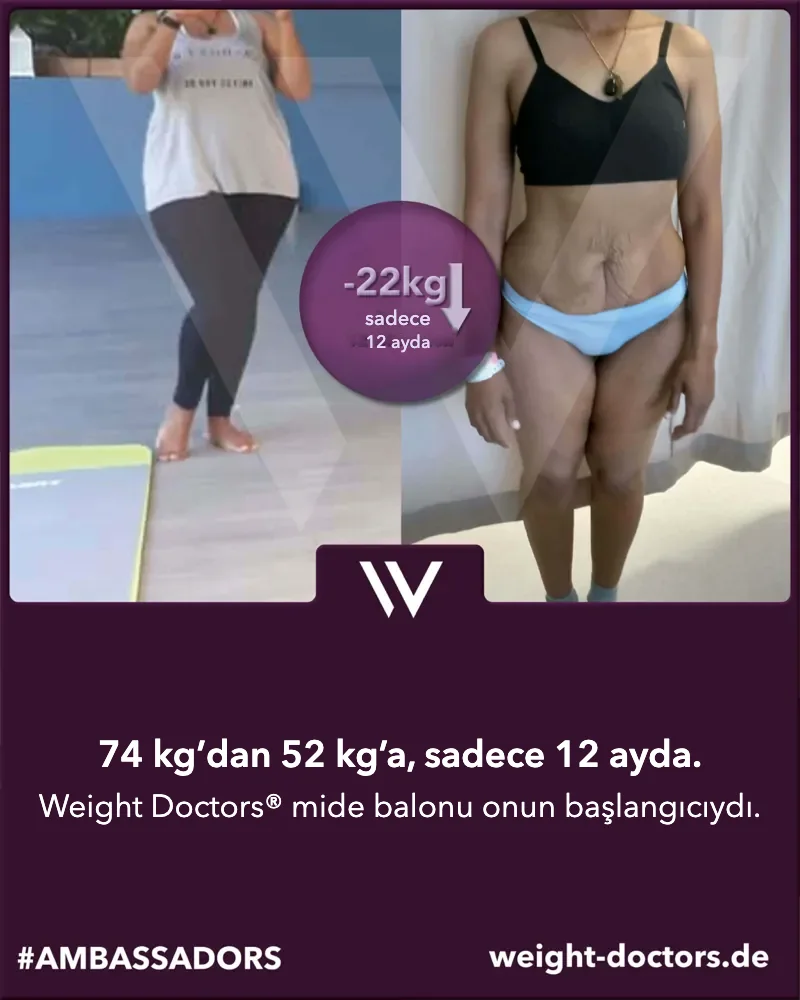 Weight Doctors® öncesi-sonrası: Weight Doctors® MİDE BALONU ile on iki ayda 74 kg’dan 52 kg’a inen bir hasta