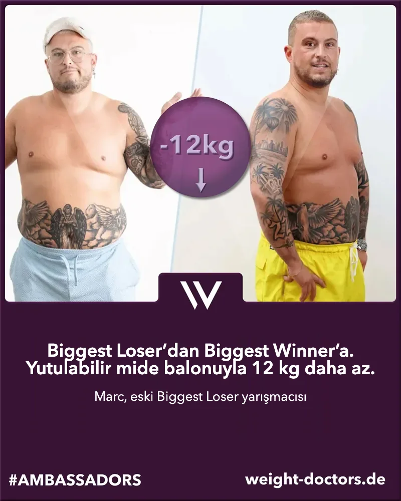 Weight Doctors® öncesi-sonrası: “The Biggest Loser” programının eski katılımcısı Marc, Allurion mide balonuyla 12 kg daha az