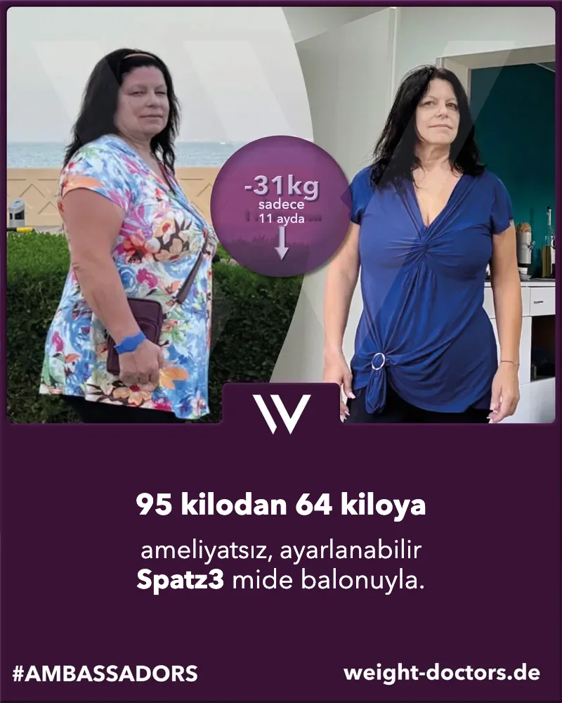 Weight Doctors® öncesi-sonrası: Ameliyatsız, ayarlanabilir Spatz3 mide balonuyla 95 kilodan 64 kiloya inen bir hasta