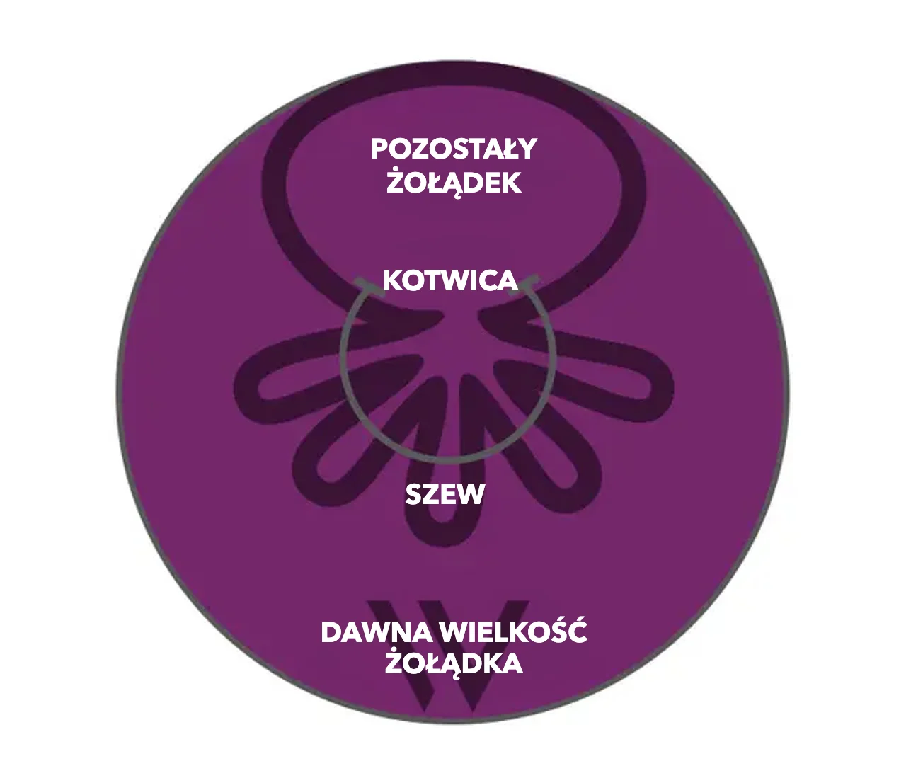 Schemat OverStitch NXT™: kotwice i szew marszczą ścianę żołądka, pozostały żołądek jest wyraźnie mniejszy niż dawna wielkość żołądka