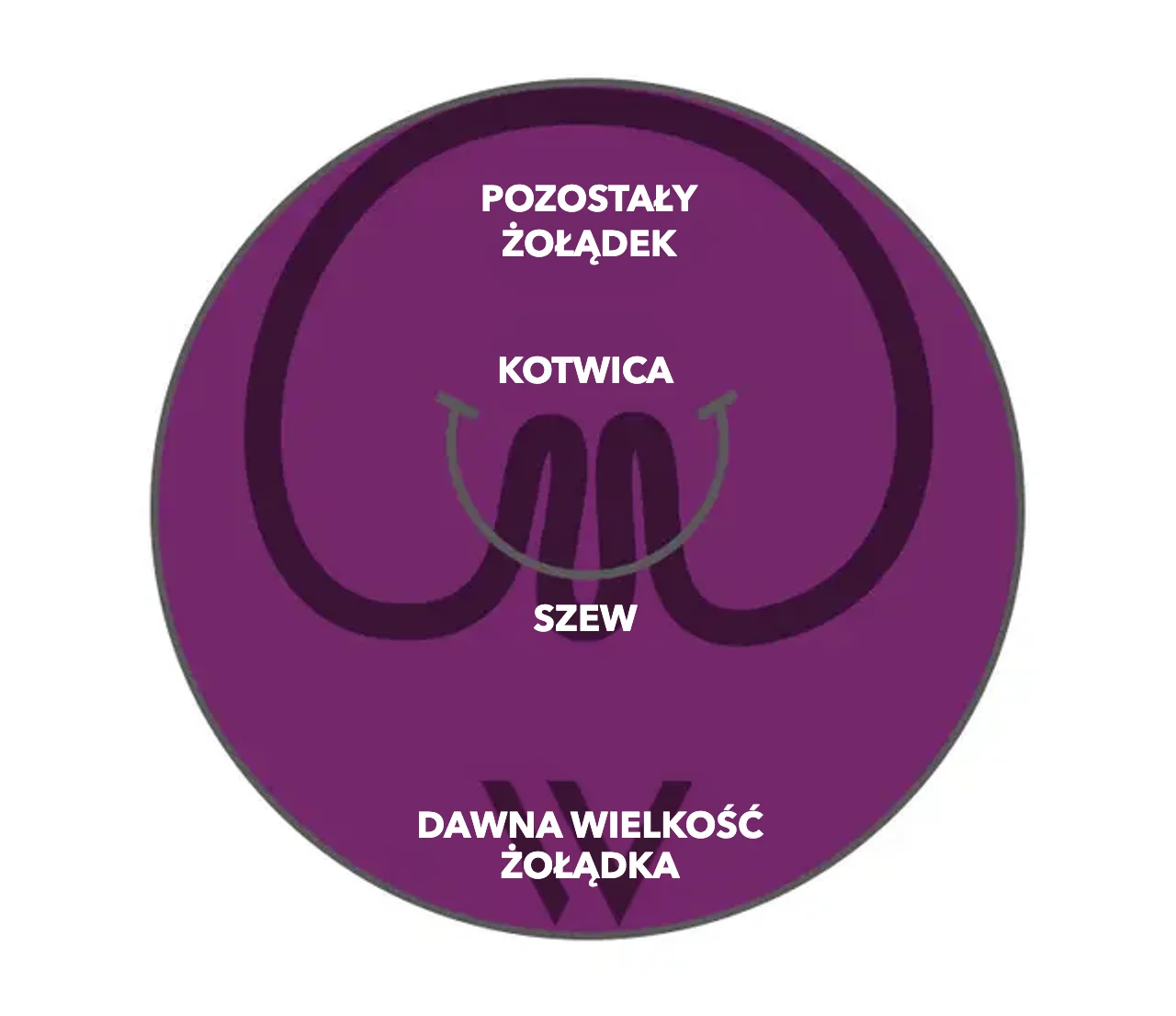 Schemat pose® 3.0 Double Helix: kotwice i szew fałdują ścianę żołądka, pozostały żołądek jest wyraźnie mniejszy niż dawna wielkość żołądka