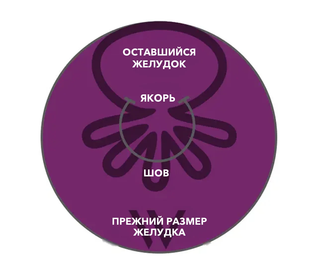 Схема OverStitch NXT™: якоря и шов собирают стенку желудка, оставшийся желудок значительно меньше прежнего размера