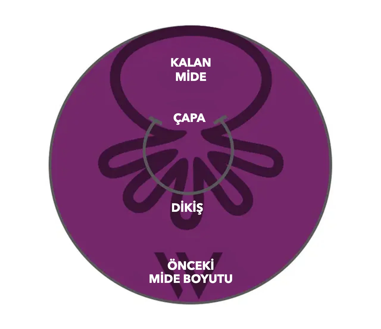 OverStitch NXT™ şeması: Çapa ve dikiş mide duvarını büzer, kalan mide önceki mide boyutundan belirgin biçimde daha küçüktür