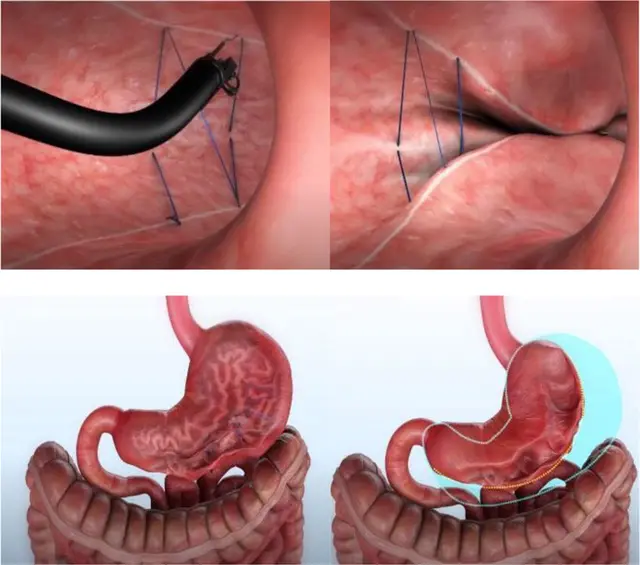 Diagram of OverStitch™: the endoscope places sutures in the stomach, below the stomach before and after gathering