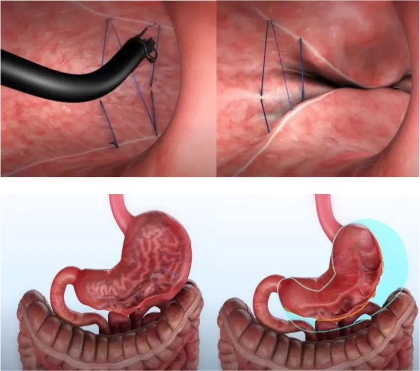 الخياطة بالمنظار باستخدام OverStitch NXT™: في الأعلى المنظار أثناء الخياطة عند جدار المعدة، وفي الأسفل المعدة قبل الإجراء وبعده مع تعليم الحجم السابق