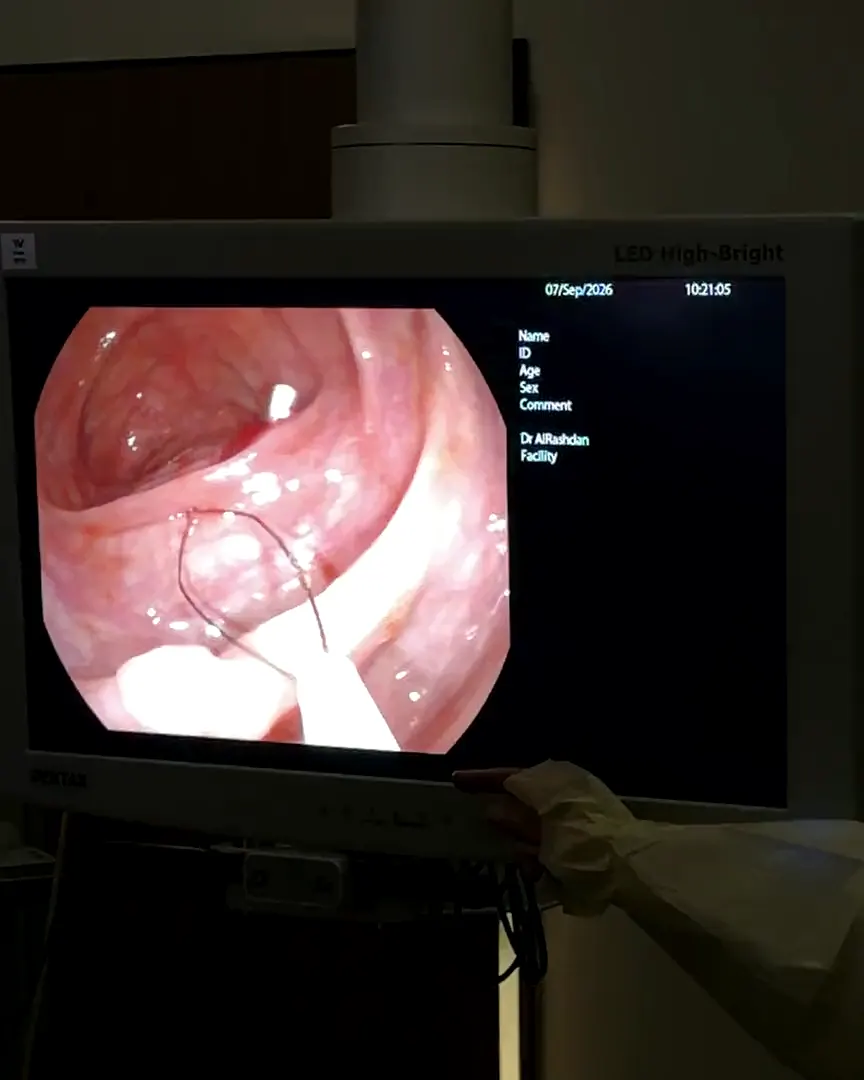 شاشة تعرض صورة الكاميرا من داخل المعدة أثناء تنظير المعدة